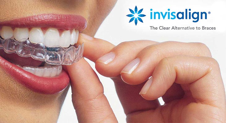 invisalign